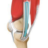 ACL Reconstruction Hamstring Tendon