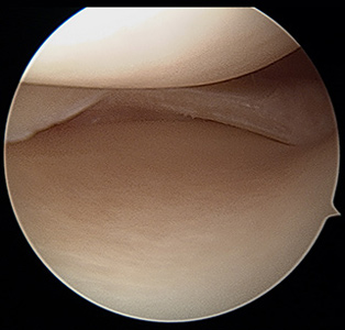 knee meniscus