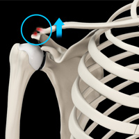 AC Joint Dislocation