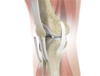 ACL Reconstruction Patellar Tendon