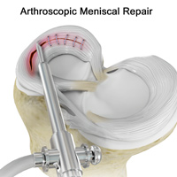 Arthroscopic Meniscus Repair