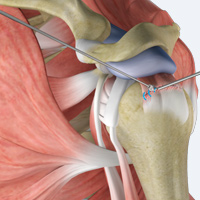 Arthroscopic Rotator Cuff Repair