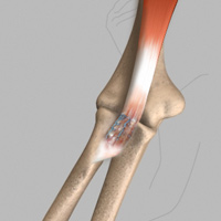 Biceps Tendon Repair