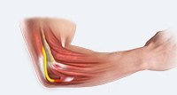 Cubital Tunnel Syndrome