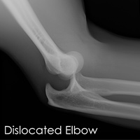 Elbow Dislocation