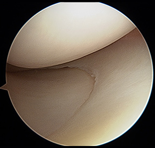 knee meniscus