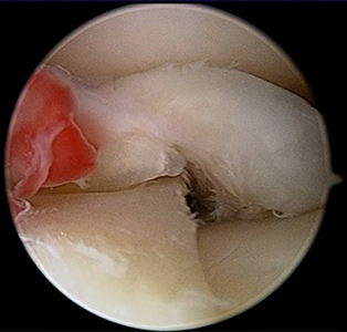 knee meniscus