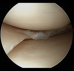 knee meniscus