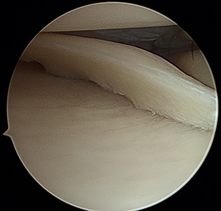 knee meniscus