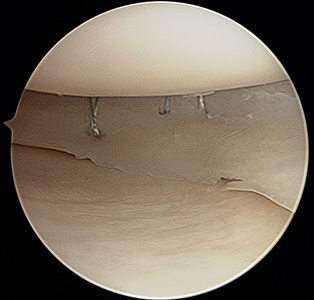 knee meniscus