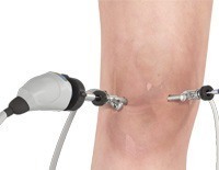 Arthroscopy of the Knee Joint