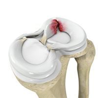 Meniscus Tear