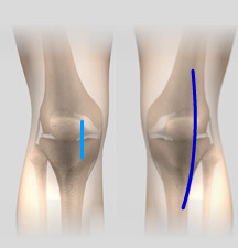 Minimally Invasive Joint Replacement