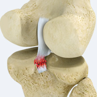 Posterior Cruciate Ligament Reconstruction