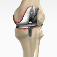 Revision Knee Replacement