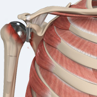 Revision Total Shoulder Replacement