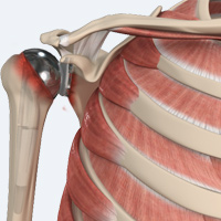 Revision Total Shoulder Replacement