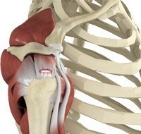 Rotator Cuff Tear