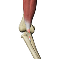 Rupture of the Biceps Tendon