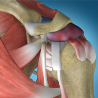 Shoulder Impingement