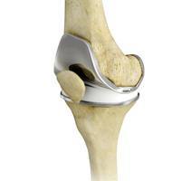 Total Knee Replacement (TKR)