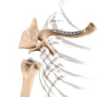 Clavicle Fracture