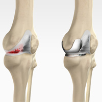 Uni condylar Knee Replacement